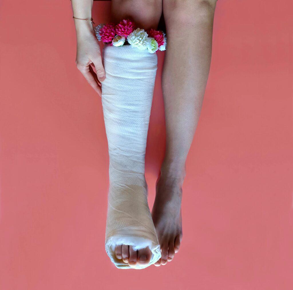 a leg with full casts for fracture management